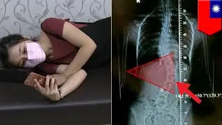 Punggung gadis ini bengkok 50 derajat karena main ponsel - TomoNews
