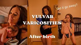 Vulvar Varicosities | After birth update|