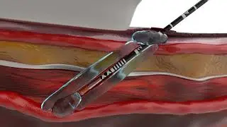 Venclose Maven™ Perforator Catheter