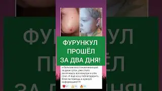 ФУРУНКУЛ ПРОШЕЛ ЗА ДВА ДНЯ. 