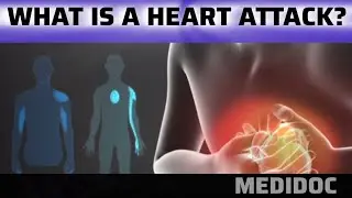 What is a HEART ATTACK (Or) Myocardial Infarction (MI) - Signs Symptoms - Diagnosis and Treatment