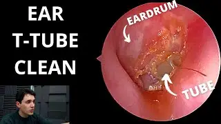 Tympanostomy Tube Cleaned (Eardrum Tube)