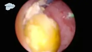 Laser for Flexible Nephroscopy