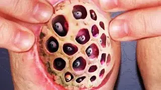 What is Trypophobia?  What Causes a Fear of Holes?