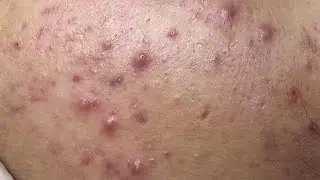 Inflamatory acne causes painful ( VA P.3) #HoangMySpa103