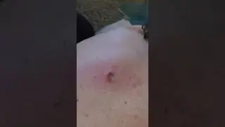 Огромный прыщ на спите ,НОВОЕ ЗАЛИПАТЕЛЬНО