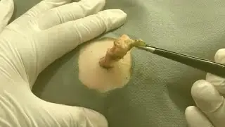 Treatment Of Blackhead Removal at Lam Dep Spa #047
