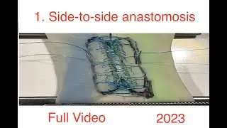 Side-to-side bowel anastomosis 2023, extended