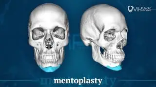 Custom Implants for plastic surgery. Vip Studio, Moscow.