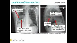 Pneumonia Part 2