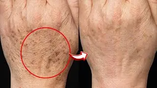 Get Baby Soft Wrinkle Free Hand At Home | Keep Your Hands Sof and Glowing