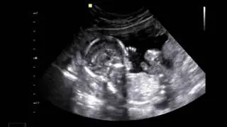 18 week ultrasound: It's a boy!