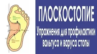 Flat feet. Prevention of valgus and foot varus.