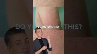 Get Rid Of CHICKEN SKIN With 1 Product! ✅