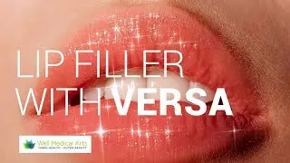 Lip Filler with Versa Dermal Filler
