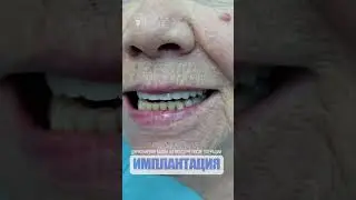 Циркониевая балка на осмотре после операции. The zirconium beam is being examined after surgery.