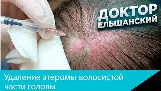 Удаление атеромы волосистой части головы