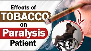 Effects of Tobacco on Paralysis Patient | Smoking Cigarette Causes Stroke | SRIAAS