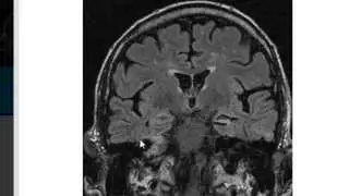 MRI in Epilepsy