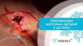 Лечение миомы матки методом ЭМА