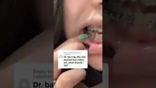 Braces Emergency: What to do for Broken Bracket on the Side