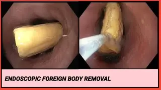 Endoscopic Foreign Body Removal Of Beef Tendon  l এন্ডোস্কপিক ফরেন বডি রিমুভাল #BD_ENDOSCOPY