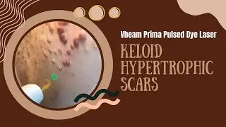 Vbeam Prima Pulsed Dye Laser | Keloid Hypertrophic Scars | West Hollywood, CA | Dr. Jason Emer