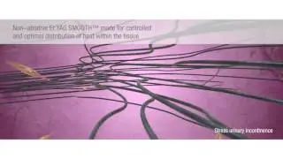 Láseres Fotona - Er:YAG en Ginecología con FotonaSmooth