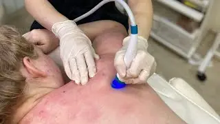 Чистка спины Хайдрафешл в Ростове на Дону. Специальная насадка и сыворотки с кислотами в Merci