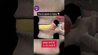 What is Disc Slip or Disc Bulging? डिस्क स्लिप | disc slippage in L4 and L5 and Lower back #bioflow