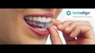 Invisalign Cardiff - How Does Invisalign Work & Cost? | Birchgrove Dental Practice