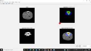 Deep learning segmentation Unet model - Brain, fundus, Liver or any  medical images -Own data
