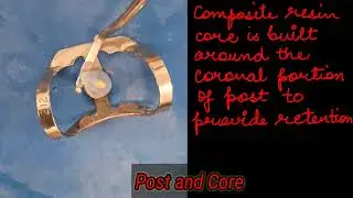 post and core procedure