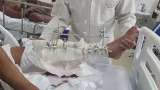 Fixador biplanar de tibia, orientações de fisioterapia @Antonio Vital Sampol