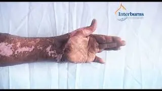 Burn physiotherapy: 4. Wrist & Hand
