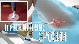 ЭРОЗИЯ шейки матки 