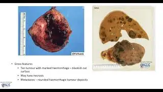 Testis and liver   Choriocarcinoma with liver metastases (Gross pathology)