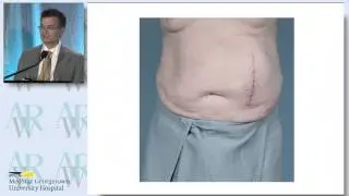 Flank Incisional Hernia Repair