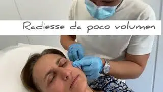 Efecto Lifting con Radiesse Inductor de Colágeno