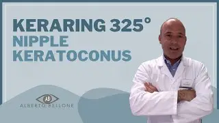 Keraring 325° First Implant in Europe for Nipple Keratoconus - MOD EYE CLINIC Italy