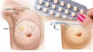 Even Low-Dose Contraceptives Slightly Increase Breast Cancer Risk.