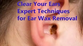 Clear Your Ears: Expert Techniques for Ear Wax Removal