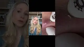 Dermatologist on Pimple Popping 
