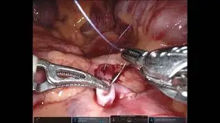 full length robotic left pieloplasty HidES