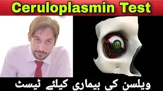 Ceruloplasmin Test | Ceruloplasmin Test in Hindi | Ceruloplasmin Biochemistry