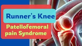 Understanding Patellofemoral Pain Syndrome: Causes & Treatments