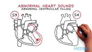 Abnormal Heartsounds and Murmurs: Which heart sounds should worry you
