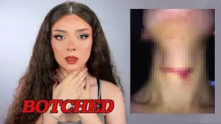 My Voice Was BOTCHED (Male to Female Transition Update)