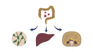 Recognizing colon cancer on abdominal CT