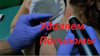 Как избавитьcя от папилом на шее,  Качественно и Безболезненно!